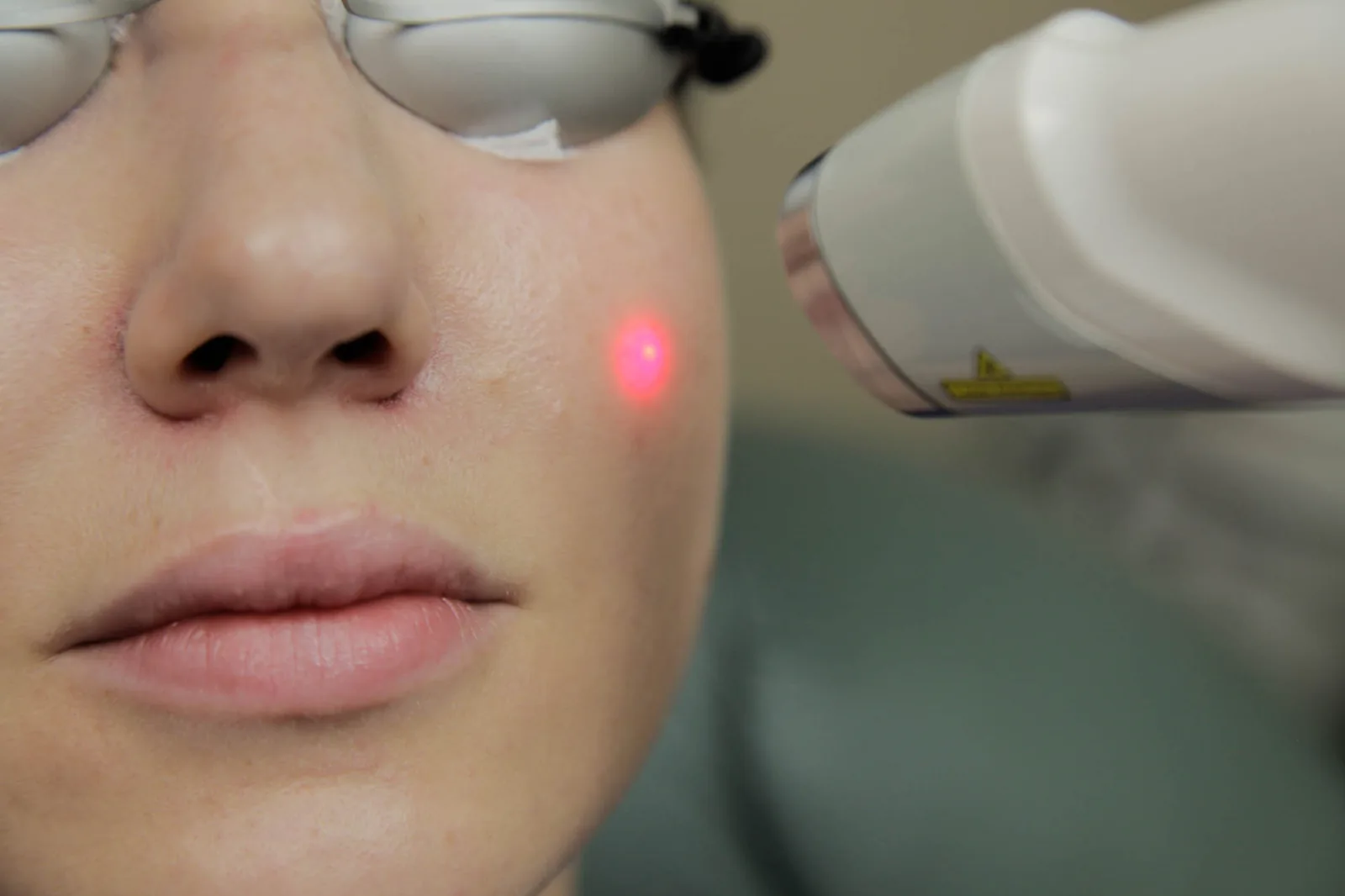 Laser treatments at Abbey Aesthetics